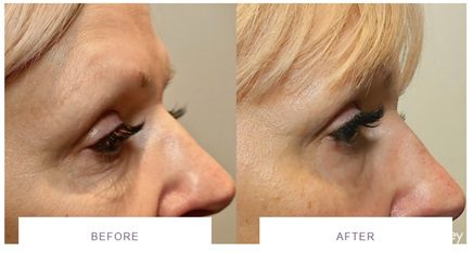 morpheus8 before and after eye wrinkles