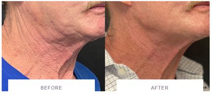 morpheus8 before and after neck lift wrinkly neck