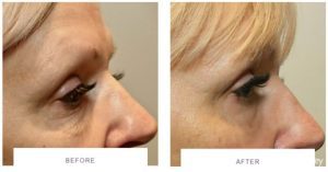 morpheus8 eyes skin tightening before after