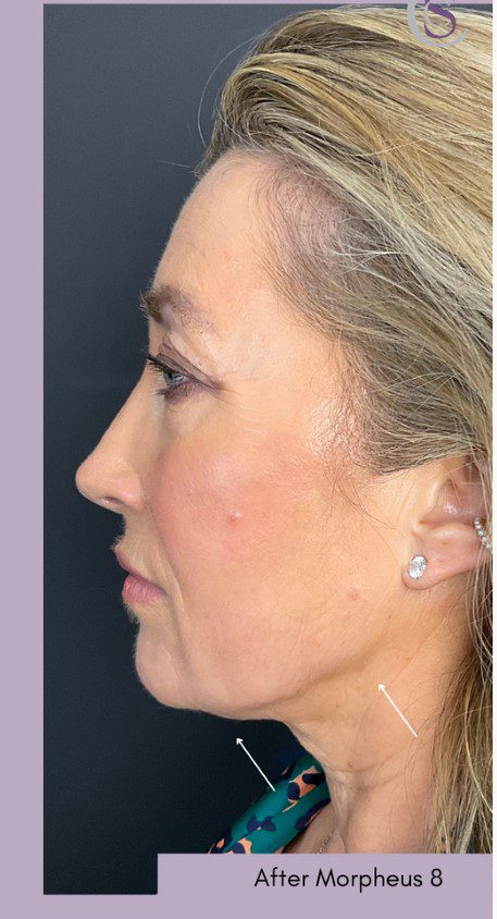 morpheus8 facelift after