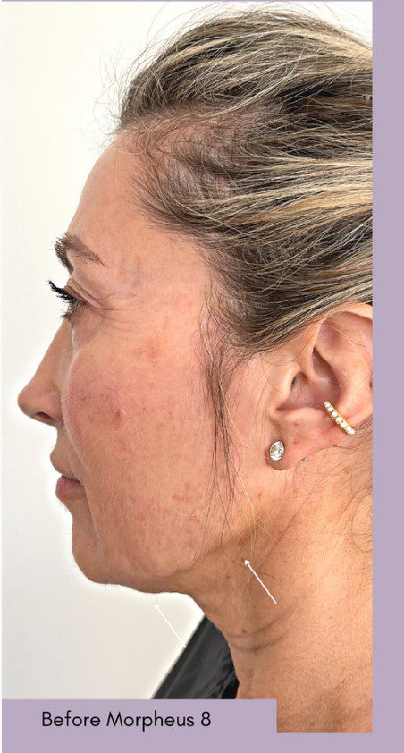 morpheus8 facelift before