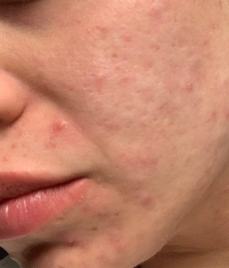 morpheus8 facial acne before