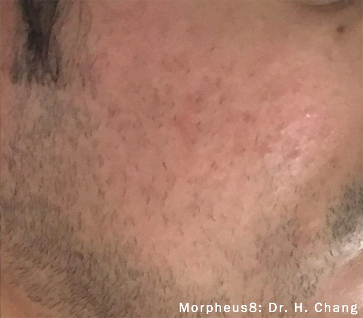 morpheus8 facial acne male patient after