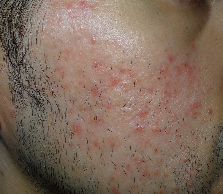 morpheus8 facial acne male patient before