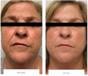 morpheus8 full face skin tightening before after