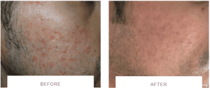 morpheus8 men acne before after