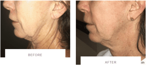 morpheus8 for wrinkly neck before and after