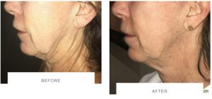 morpheus8 neck skin tightening before after