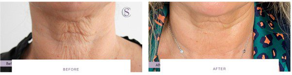 morpheus8 wrinkly neck skin tightening before after