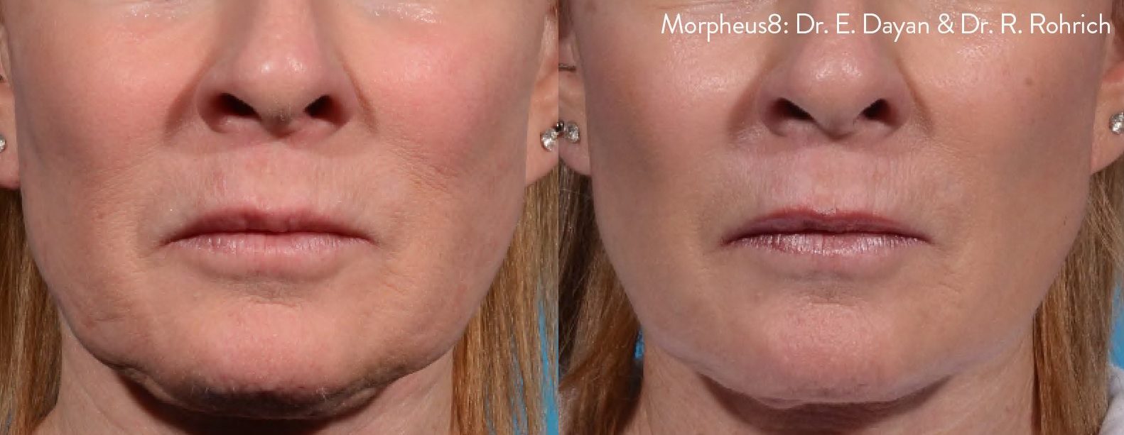 morpheus8 skin tightening lip lines jowls before and after
