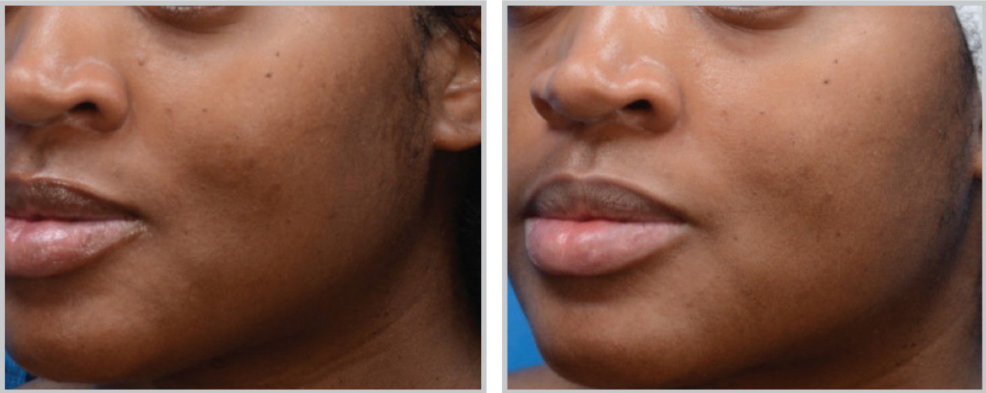 moxi laser dark spots on face before and after
