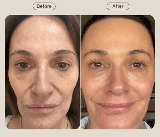 moxi laser skin tightening skin glow before and after results - post summer skin