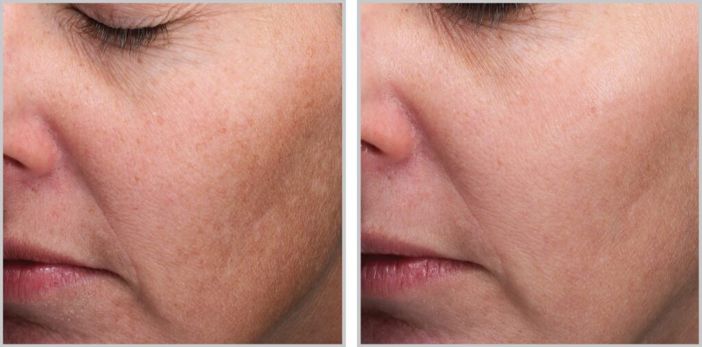moxi laser sun spots hyperpigmentation before and after