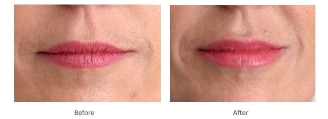 Lip Enhancement treatment Natural Pout Lip Filler