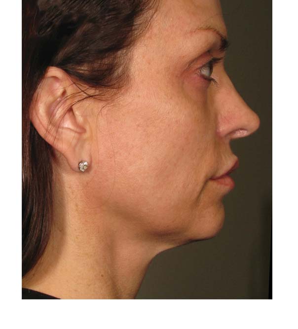 A lady who has had Ultherapy ultrasound to lift and tighten the skin