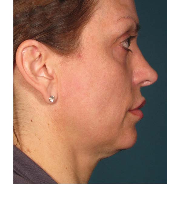 A profile image of a lady before having Ultherapy treatment
