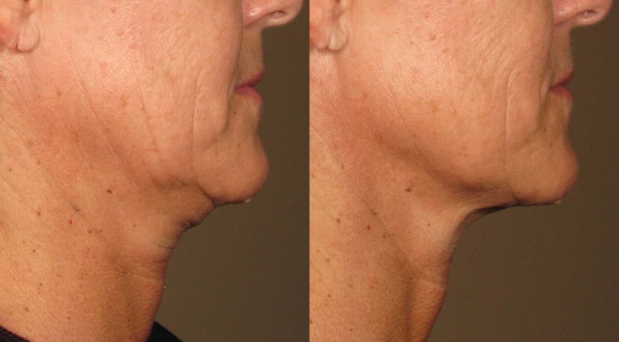 neck lift ultherapy before and after