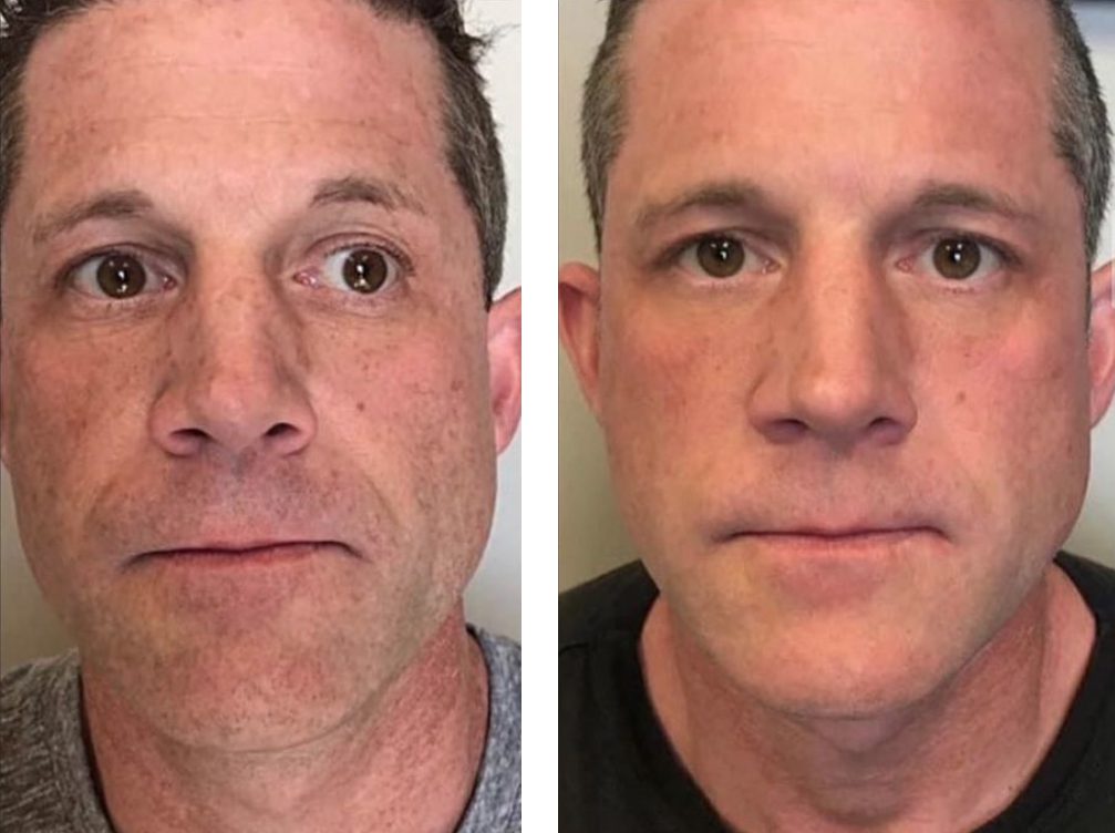 neogen plasma treatment before after face on male