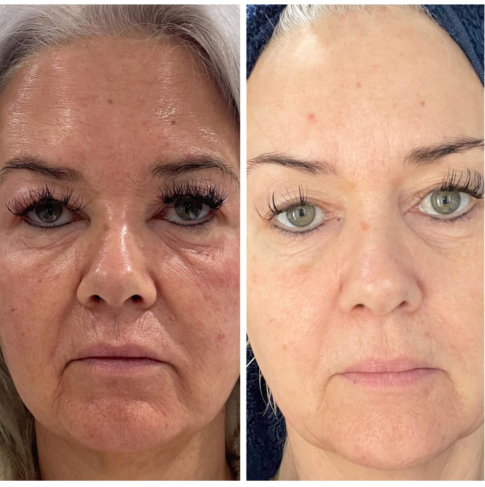 neogen plasma treatment before after face on