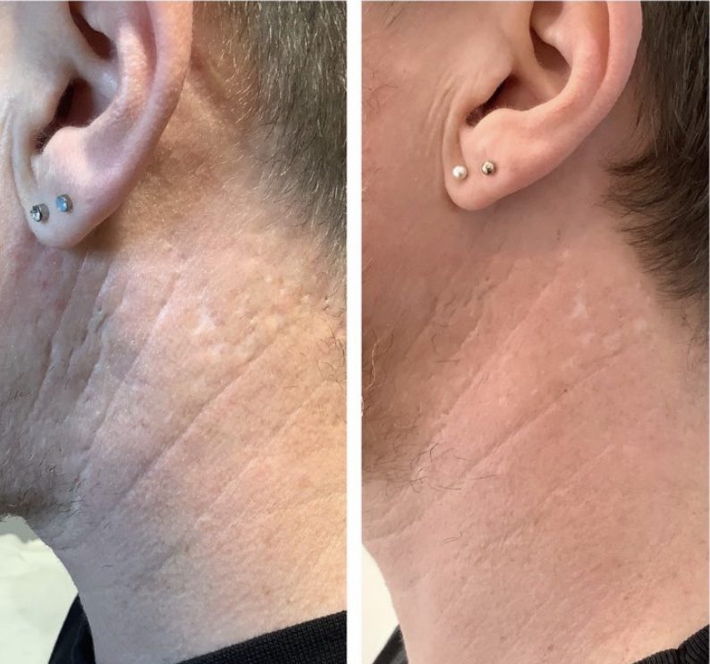 neogen plasma treatment before after - neck - male
