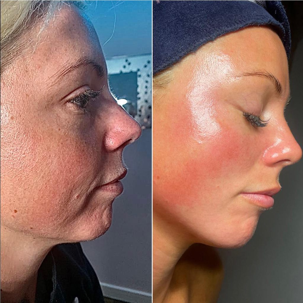 neogen plasma treatment - before after side profile