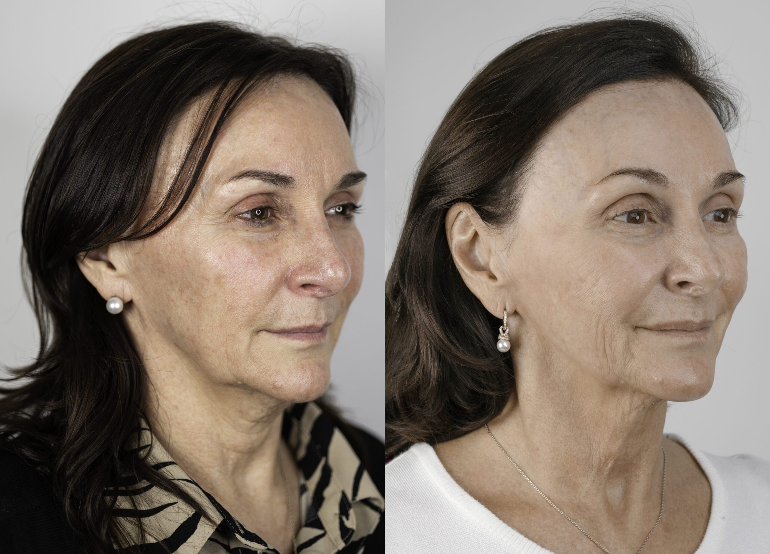 NeoGen plasma treatment - before and after