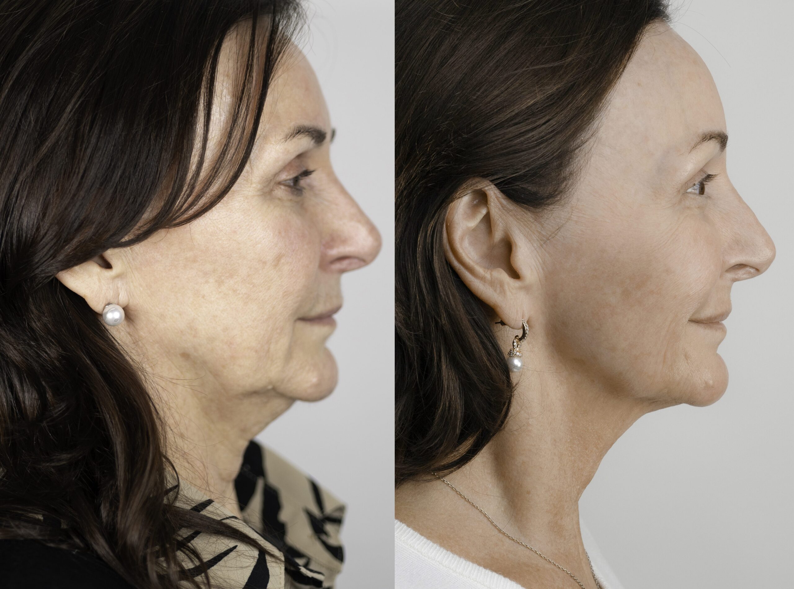 neogen plasma treatment side profile - before and after