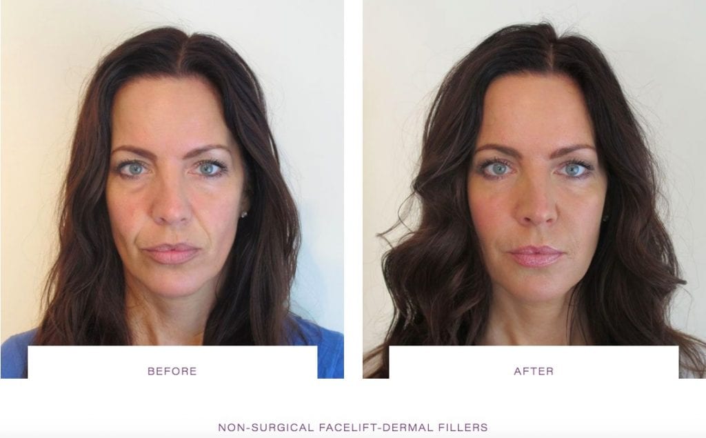 non surgical face lift, dermal fillers, dermal fillers before and after