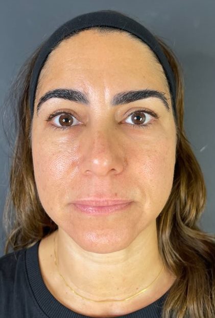 non surgical face lift dermal fillers before nicole
