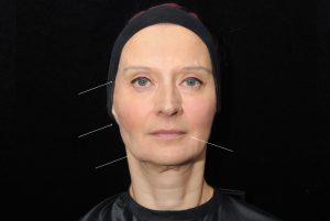 non surgical facelift Teoxane jawline Filler After Front
