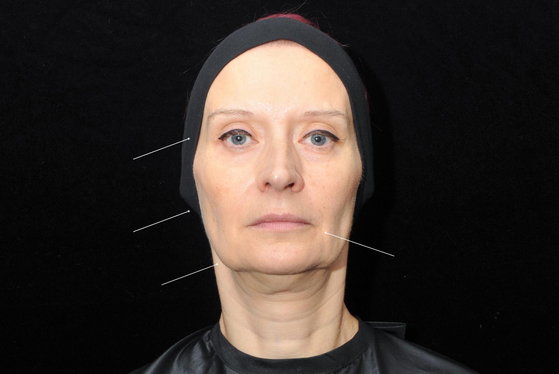 non surgical facelift Teoxane jawline Filler Before Front