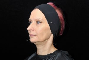 non surgical facelift Teoxane jawline Filler Before Side
