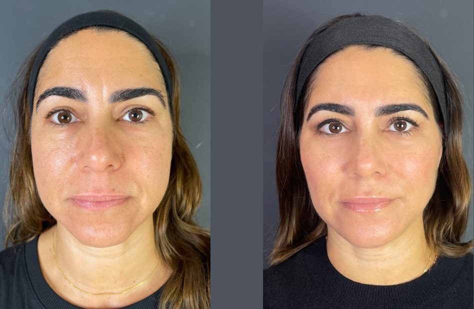 non surgical facelift dermal fillers before and after