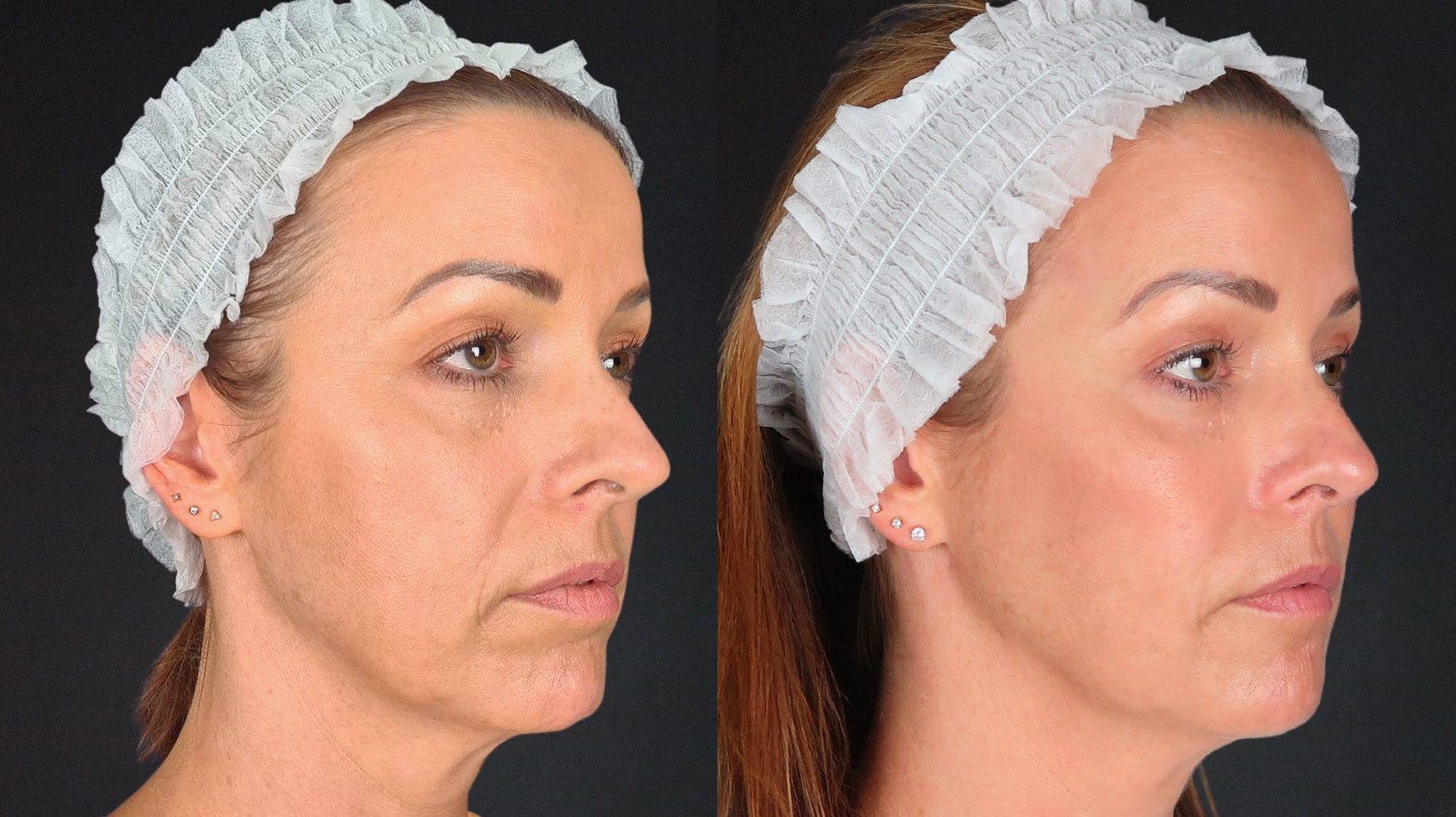 non surgical facelift - fillers in the lower face before and after by Dr Johanna Ward