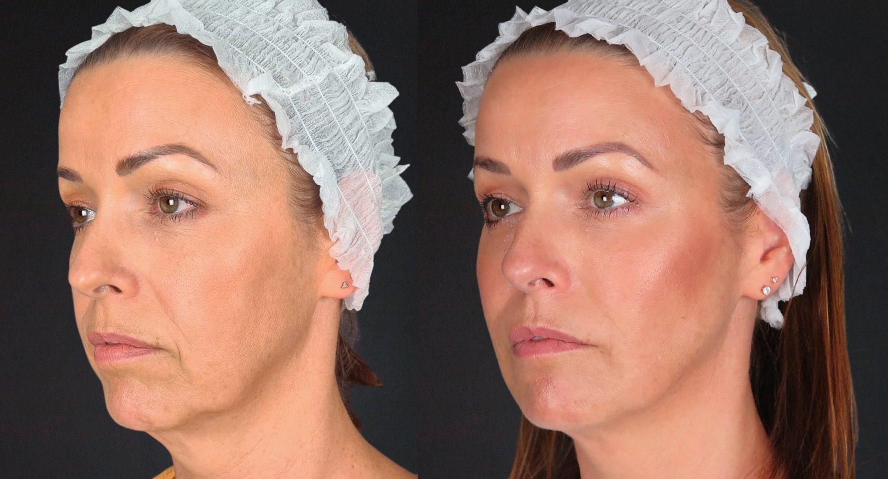 non surgical facelift - lower facelift before and after by Dr Johanna Ward