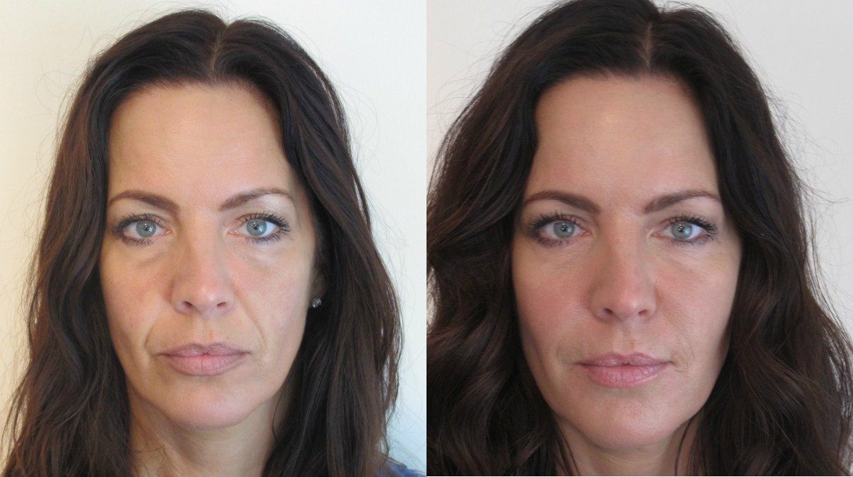 non-surgical facelift with botox before and after - nasolabial folds - eye lift