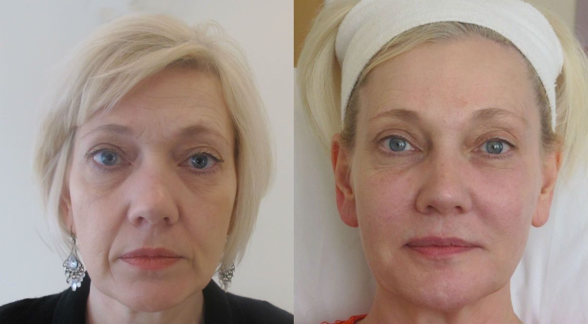 non surgical lower face lift dermal fillers before and after