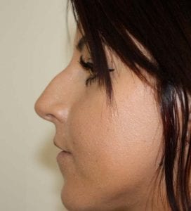 non surgical nose job rhinoplasty before