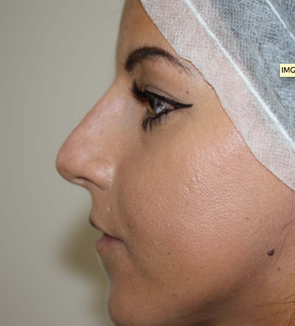 After image of non-surgical rhinoplasty and non-surgical nose job