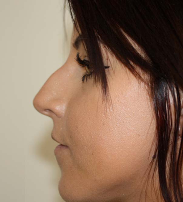 Before image of non-surgical rhinoplasty and non-surgical nose job