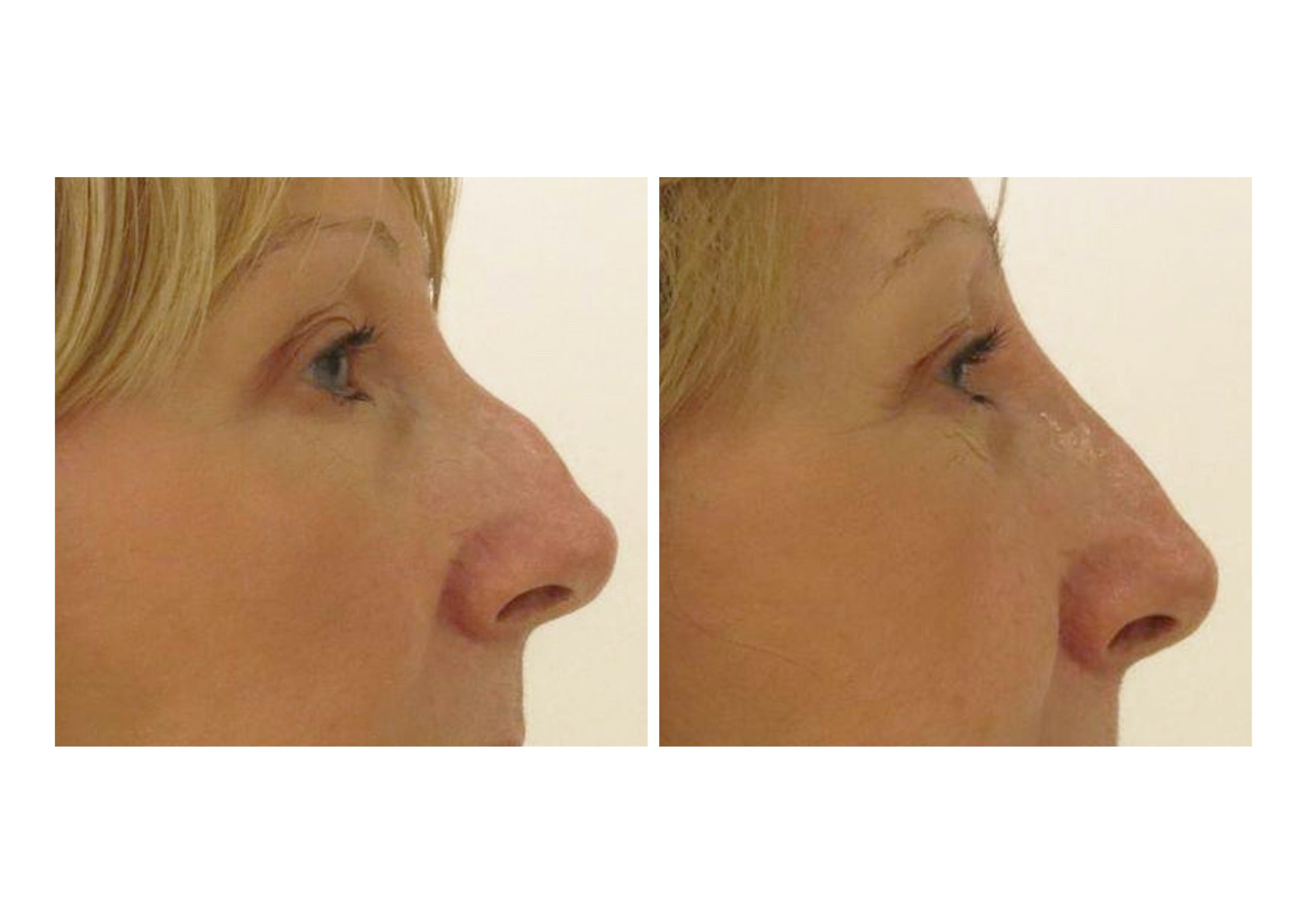 non surgical rhinoplasty before and after by Dr Johanna Ward