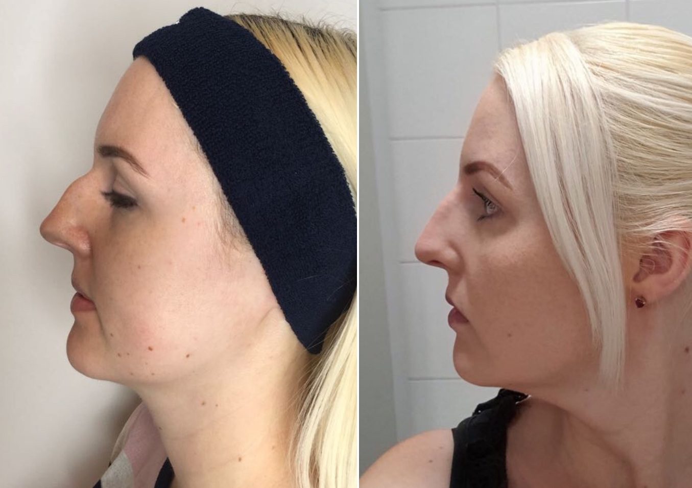 patient with non surgical rhinoplasty treatment before and after results