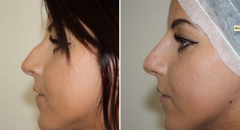 nose filler before and after nose bridge filler non surgical rhinoplasty before and after
