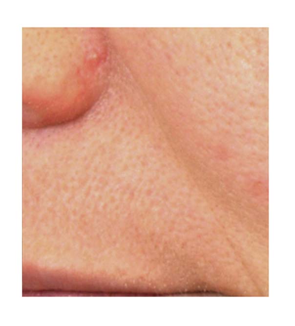 A nose-to-mouth line that has been reduced by using Pelleve
