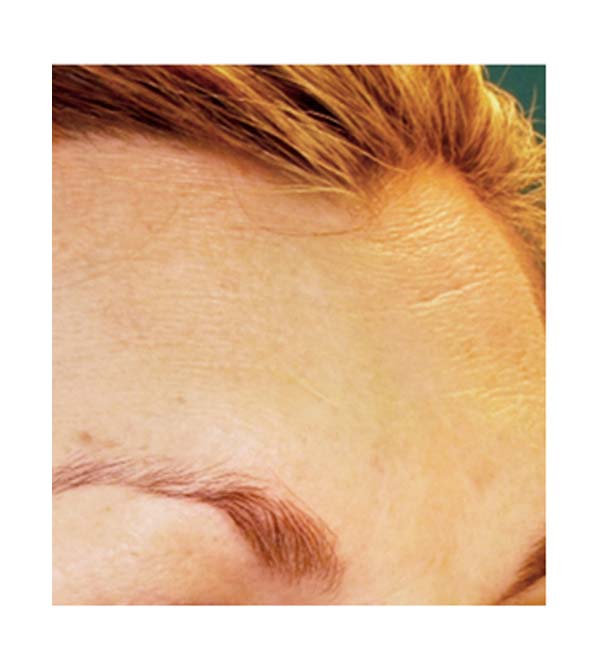 A close up of a forehead following treatment with Pelleve skin tightening