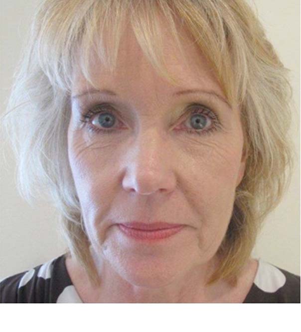 A lady before skin tightening treatment