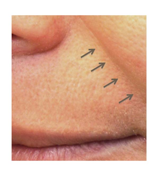 A close up of a nose-to-mouth line before Pelleve treatment