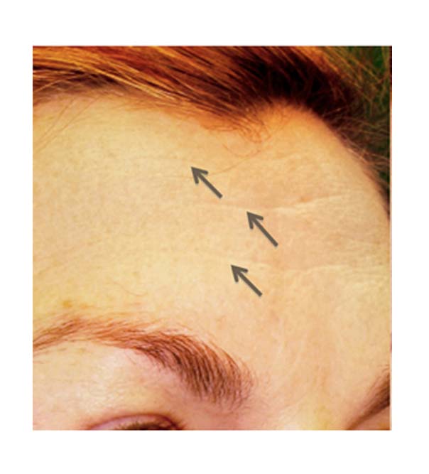 A close up of lines on the forehead