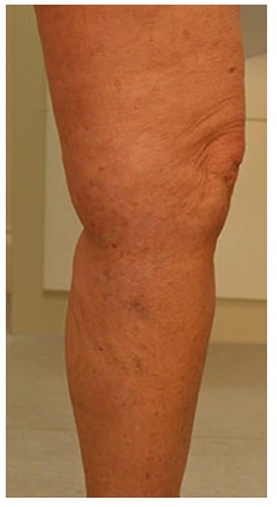 phlebectomy varicose veins treatment london after