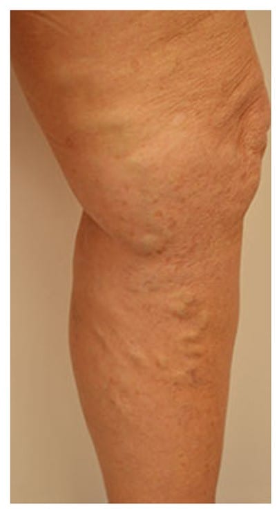 phlebectomy vericose vein treatment london